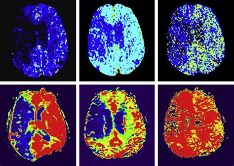 CT Perfusion Imaging in Acute Stroke | Radiology Key