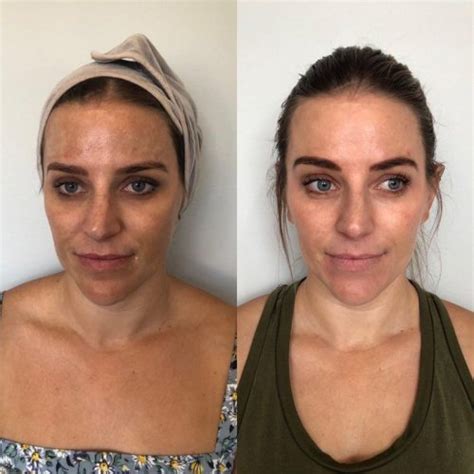 Cosmelan Depigmentation Peel Sanctuary Skin Care