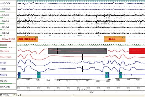 10 Excerpts From An Overnight Polysomnogram Psg Tracing Showing An