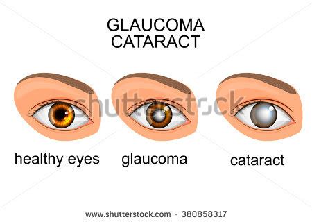 Cataract clipart 20 free Cliparts | Download images on Clipground 2024