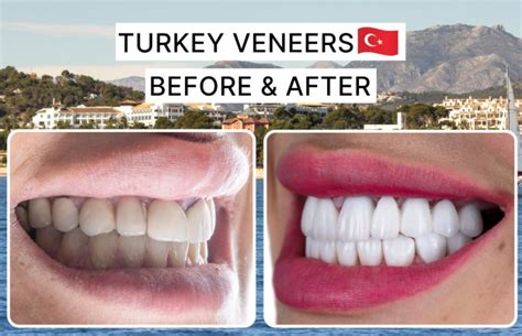 Turkey Veneers Before and After – Parmire