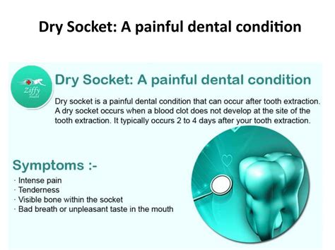 Dry Socket: A painful dental condition by ziffytech07 - Issuu