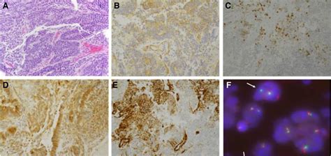 Dicer Associated Metastatic Abdominopelvic Primitive Neuroectodermal