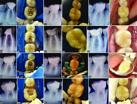 Subgingival Cavity In 1a 46 Mo 2a 46 Do 3a 46 Do 4a 46