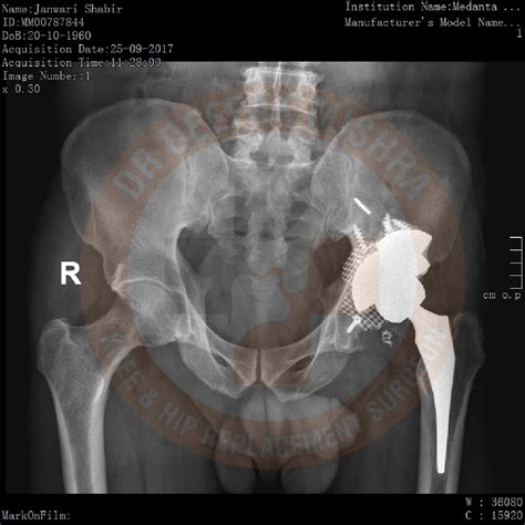 Primary And Revision Total Hip Replacement Surgery