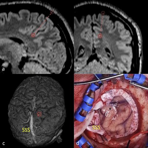 Intraoperative Definition Of Bottom Of Sulcus Dysplasia Using