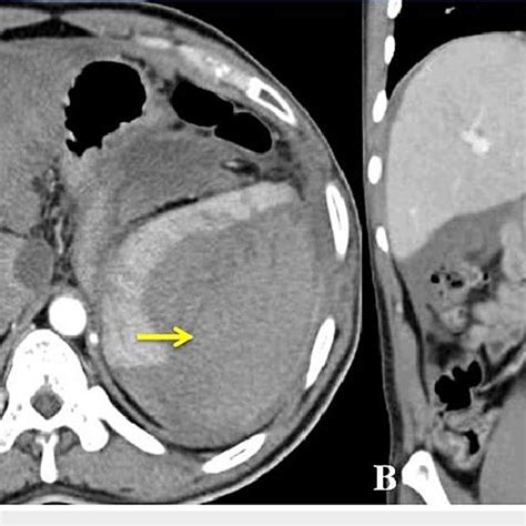 Computed tomography showing arterial phase showing perisplenic hematoma ...