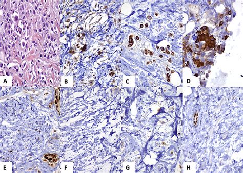 Breast Metastasis Of Gastric Signet Ring Cell Carcinoma A Case Report