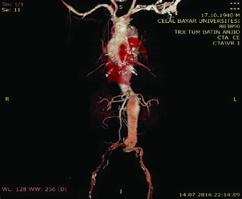 Preoperative 3 Dimensional Ct Angiography Reconstruction Hostile Neck