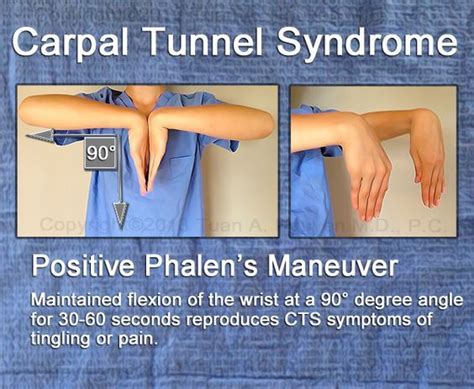 Pin On Carpal Tunnel And Cubital Tunnel