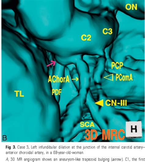 Pdf Differential Diagnosis Of The Infundibular Dilation And Aneurysm Of Internal Carotid