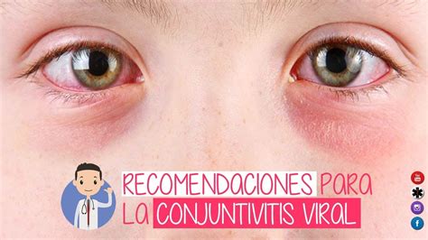 Conjuntivitis Viral Sintomas Y Tratamiento Youtube