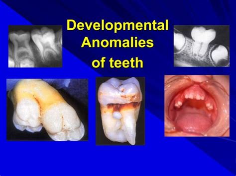 Radiographic Assessment Of Teeth Developmental Anomalies Ppt