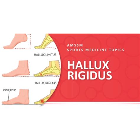 HALLUX RIGIDUS | Sports Medicine Today