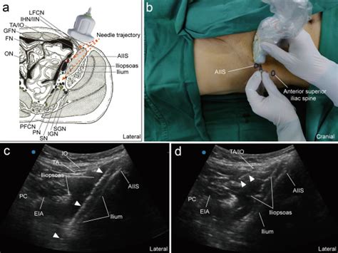 Sciatic Nerve Block Anterior Approach