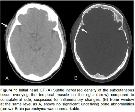 Secondary Syphilis With Bone Involvement Of The Skull A Case Report