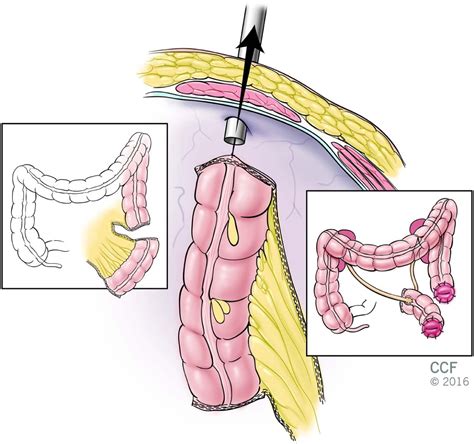 Robotic Total Pelvic Exenteration With Intracorporeal Sigmoid Conduit