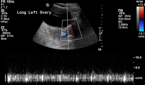 Ovarian Torsion Uams Department Of Radiology