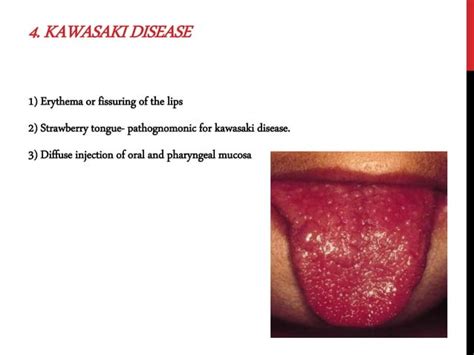 Oral Manifestations Of Systemic Disease Ppt