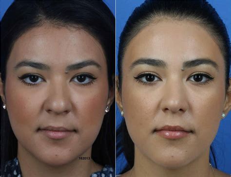 Buccal Fat Removal In New York City Dr Philip Miller