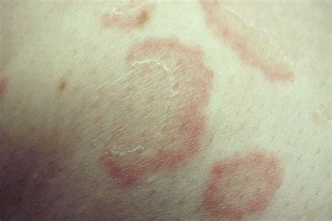 Arcuate Rash