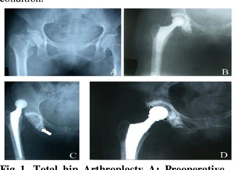 Functional Outcome With Bipolar Hemiarthroplasty As Against Total Hip