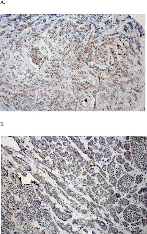 P120 Catenin A And E Cadherin B Expression In Pacs Neoplastic Download Scientific Diagram