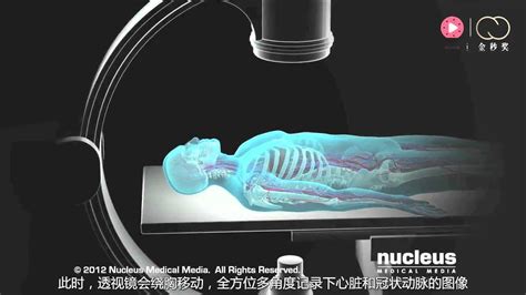 3d医学动画冠脉造影术高清1080p在线观看平台腾讯视频