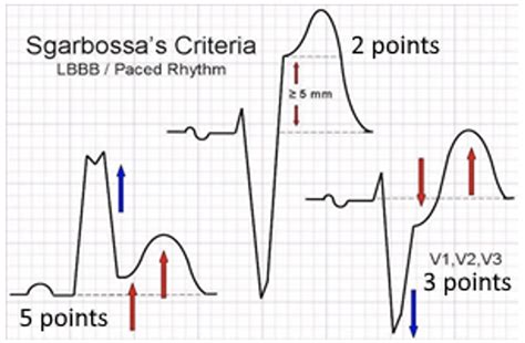 STEMI & Acute Coronary Syndrome: Tombstone — Emergency Medicine Board ...