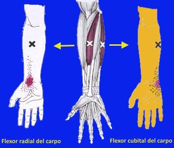 Tendinitis Del Cubital Anterior