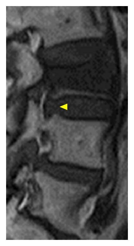 T1 A And T2 Weighted Sagittal B Magnetic Resonance Mr Imaging Download Scientific