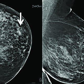 Ultrasound images showing (A) benign PT with lobulated margin (B ...