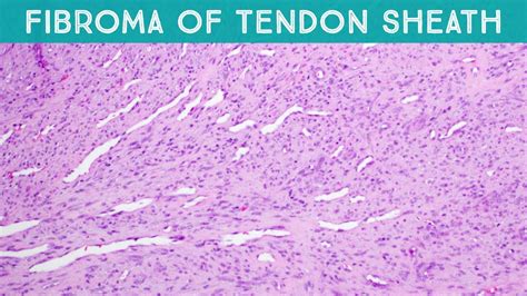 Fibroma Of Tendon Sheath Explained In 5 Minutes Finger Mass Dermpath