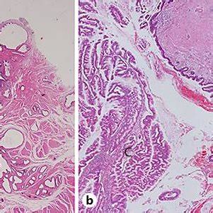 Histological Findings A Meckel Diverticulum A And Ectopic Pancreatic