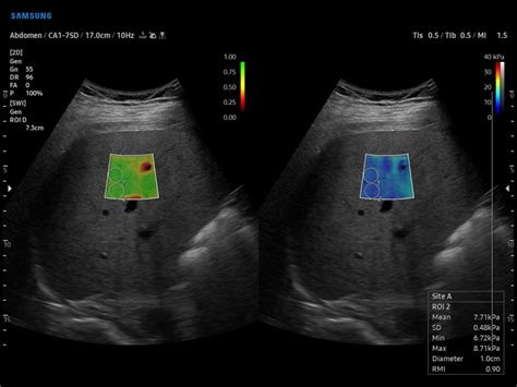 Ultrasound Images Liver S Shearwave Echogramm №928