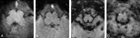 Germinal Matrix Hemorrhage