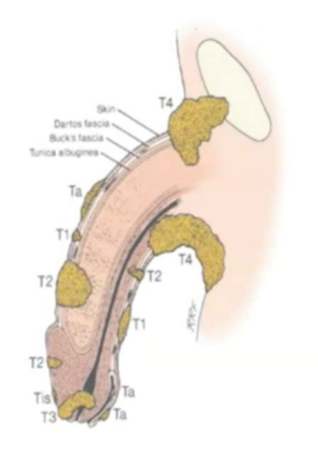 Penile Carcinoma