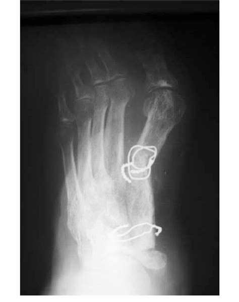 A Postoperative Radiograph Shows Reconstruction With Iliac Crest Download Scientific Diagram