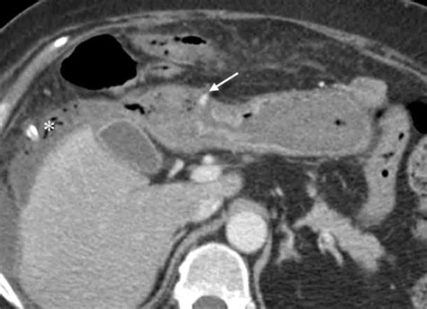 Ct Of Gastric Emergencies Radiographics