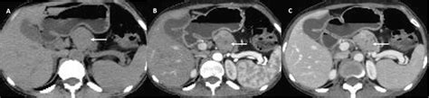 Pancreatic ductal adenocarcinoma. Axial ( ) and precontrast ( )... | Download Scientific Diagram