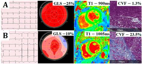 Jcm Free Full Text Electrocardiographic Markers Of Adverse Left