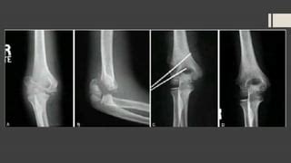 Fractura De Epicondilo Medial Y Lateral Pptx