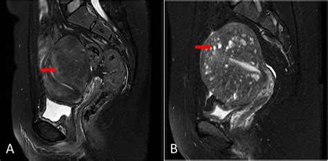 High Intensity Focused Ultrasound Treatment Of Adenomyosis The