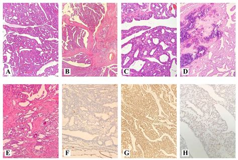 30 A Very Rare Retiform Sertoli Leydig Cell Ovarian Tumor With