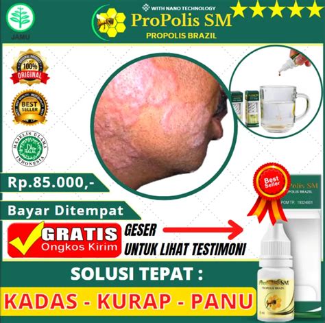 Obat Penghilang Kadas Kurap Paling Berkhasiat Salep Panu Jamur Pada