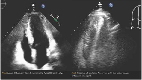 Apical Hypertrophic Cardiomyopathy Symptoms