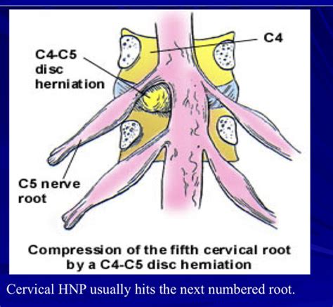 Cervical Disc Disease Radiculopathy Final Exam Flashcards Quizlet