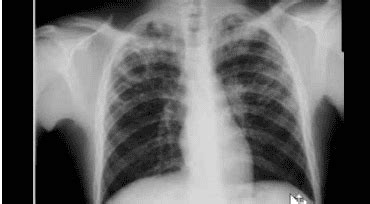 The basic lesions in lung disease detected on X-ray | Vinmec