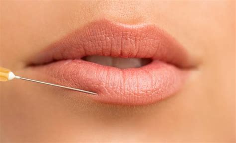 Preguntas más frecuentes en tratamientos de aumento de labios