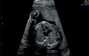 Echocardiography Advanced Fetal Diagnostic Testing Fetal Care